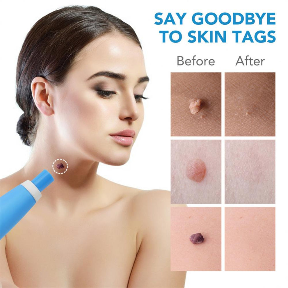 Person holding the easy-to-use skin tag tool over their arm.