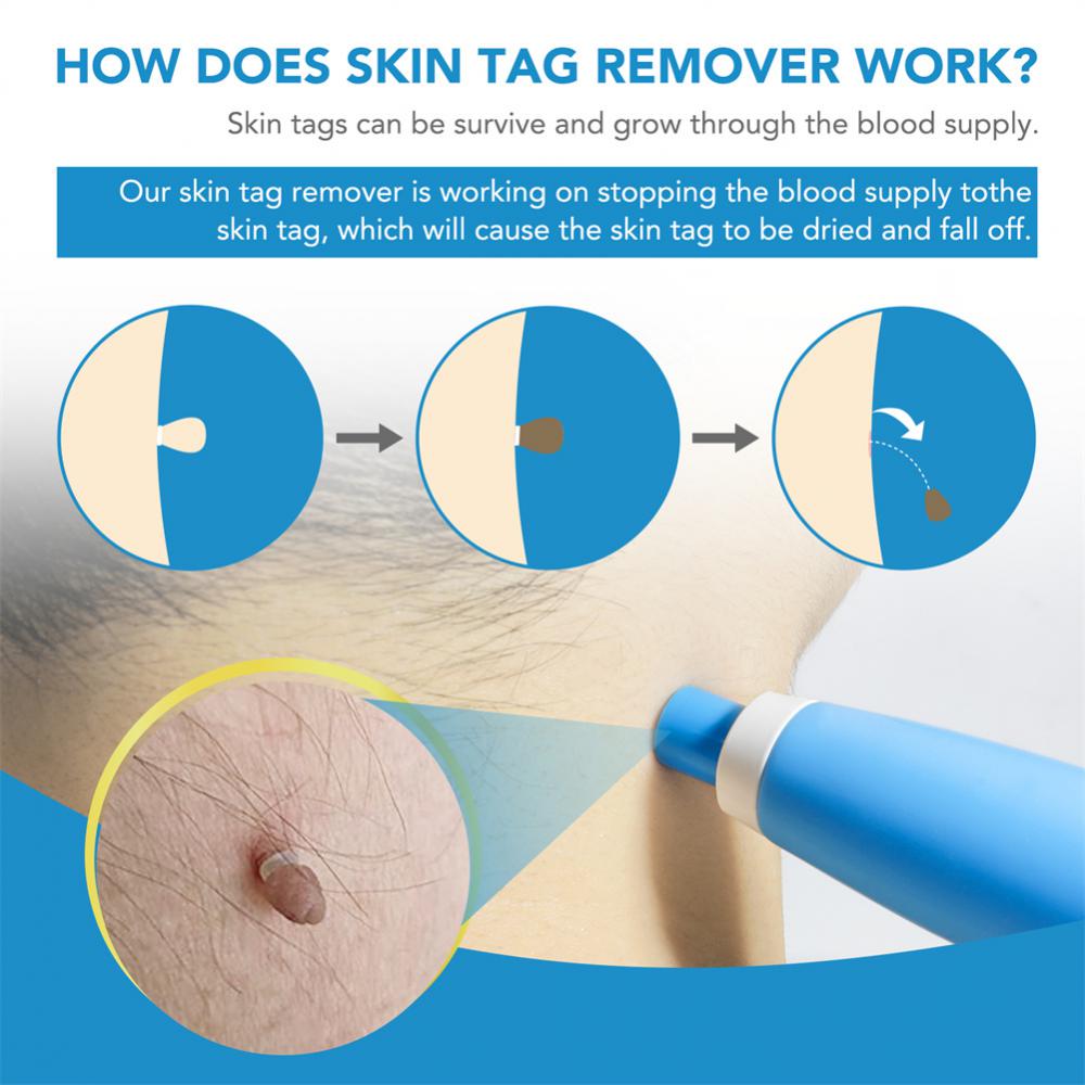 Skin Tag Remover Kit - Starqon